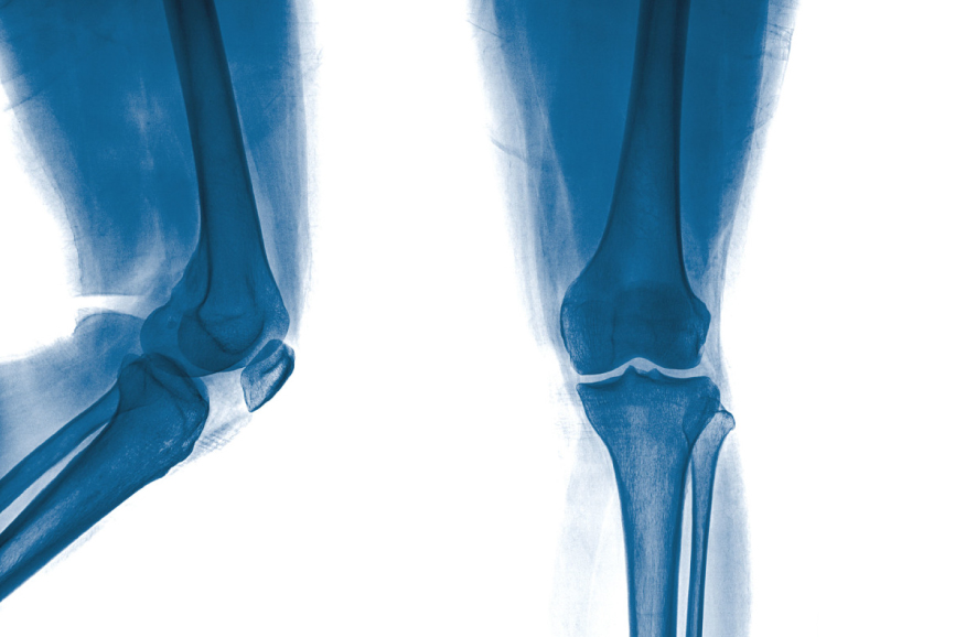 Challenges Facing Joint Replacement Registries